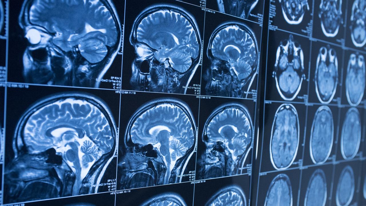 brain-scan-shows-19yo’s-shock-diagnosis
